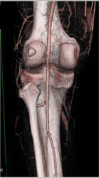 Normal Popliteal Artery - CTisus CT Scan