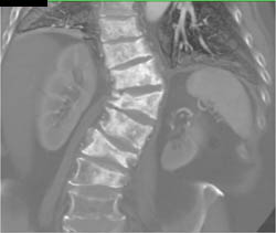 Sclerotic Bone Metastases Due to Prostate Cancer - CTisus CT Scan