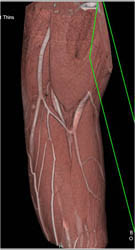 Normal Forearm - CTisus CT Scan