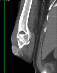 Gout - CTisus CT Scan