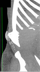 Gout - CTisus CT Scan