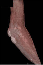 Gout - CTisus CT Scan