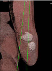 Gout - CTisus CT Scan