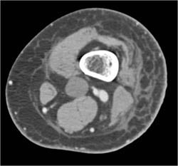 Cellulitis - CTisus CT Scan