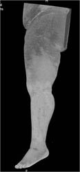 Cellulitis - CTisus CT Scan