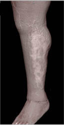 Cellulitis - CTisus CT Scan