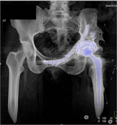 Total Hip Replacement (THR) S/P Repair With Cup Slippage - CTisus CT Scan