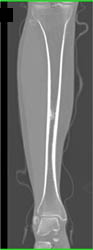 Osteoid Osteoma - CTisus CT Scan