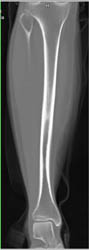 Osteoid Osteoma - CTisus CT Scan