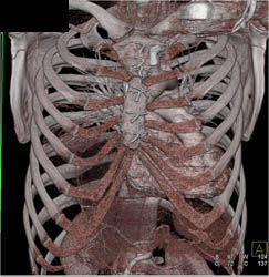 Severe Pectus Deformity - CTisus CT Scan