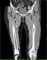 Myositis Left Thigh - CTisus CT Scan