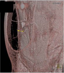 DIEP Flap Planning - CTisus CT Scan