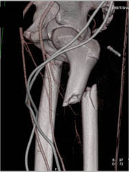 Femur Fracture - CTisus CT Scan