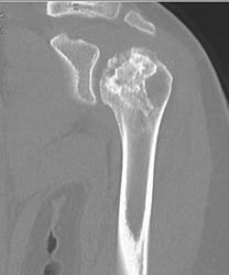 Avascular Necrosis (AVN) Shoulder - CTisus CT Scan