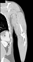 Occlusion of Brachial Artery Segment - CTisus CT Scan