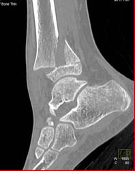 Fracture Through Epiphyseal Plate - CTisus CT Scan