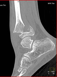 Fracture Through Epiphyseal Plate - Musculoskeletal Case Studies ...