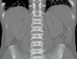 Sickle Cell Disease - CTisus CT Scan