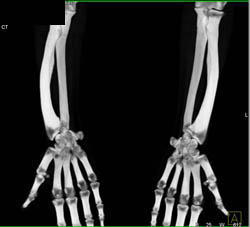 Madelung Deformity - CTisus CT Scan