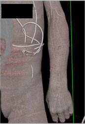 Ulna Fracture Due to Dog Bite- Rottweiler - CTisus CT Scan