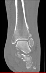 Calcaneal Fracture - CTisus CT Scan