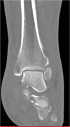 Calcaneal Fracture - CTisus CT Scan