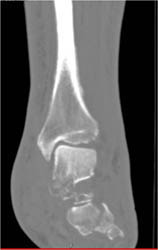 Calcaneal Fracture - CTisus CT Scan