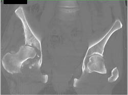 Infected Hip and Sacroiliac Joint- HIV and Intravenous Drug Abuse (IVDA) - CTisus CT Scan