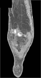 Muscle Atrophy - CTisus CT Scan