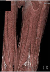 Patent CTA With Prominent Venous Collaterals- See Sequence - CTisus CT Scan