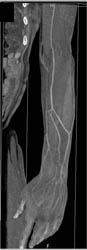 CTA Cellulitis - CTisus CT Scan