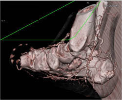 Fused Ankle - CTisus CT Scan