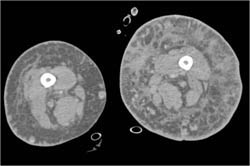 Cellulitis and Lymphadenoma - CTisus CT Scan