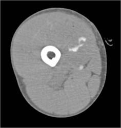 Bleed Thigh Due to GSW - CTisus CT Scan