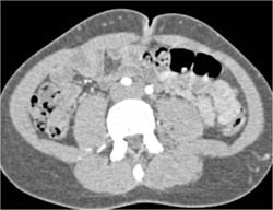 Klippel Trenauney Weber Syndrome - CTisus CT Scan