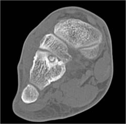 Osteoid Osteoma - CTisus CT Scan