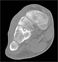 Osteoid Osteoma - CTisus CT Scan