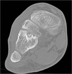 Osteoid Osteoma - CTisus CT Scan