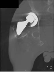 Total Hip Replacement (THR) With Resorbed Bone in Acetabulum - CTisus CT Scan