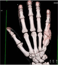 Arthrogram of the 5th Digit - CTisus CT Scan