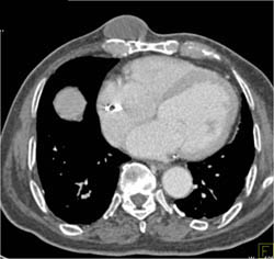 Subcutaneous Cyst - CTisus CT Scan