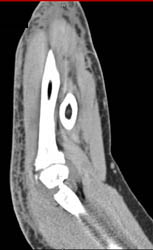 Joint Effusion and Cellulitis - CTisus CT Scan