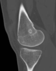 Osteoid Osteoma - CTisus CT Scan