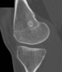 Osteoid Osteoma - CTisus CT Scan