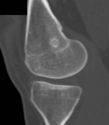 Osteoid Osteoma - CTisus CT Scan