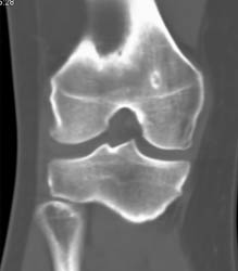 Osteoid Osteoma - CTisus CT Scan