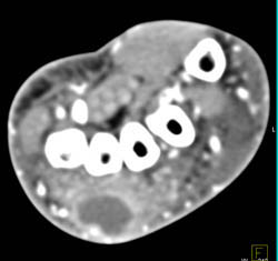 Abscess Wrist - CTisus CT Scan