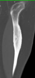 Osteoid Osteoma - CTisus CT Scan