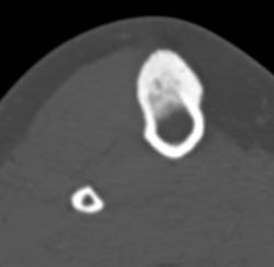 Osteoid Osteoma - CTisus CT Scan