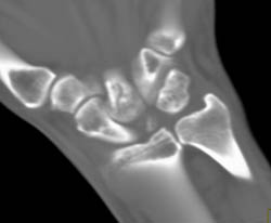 Carpal Fracture Missed on Plain Films - CTisus CT Scan